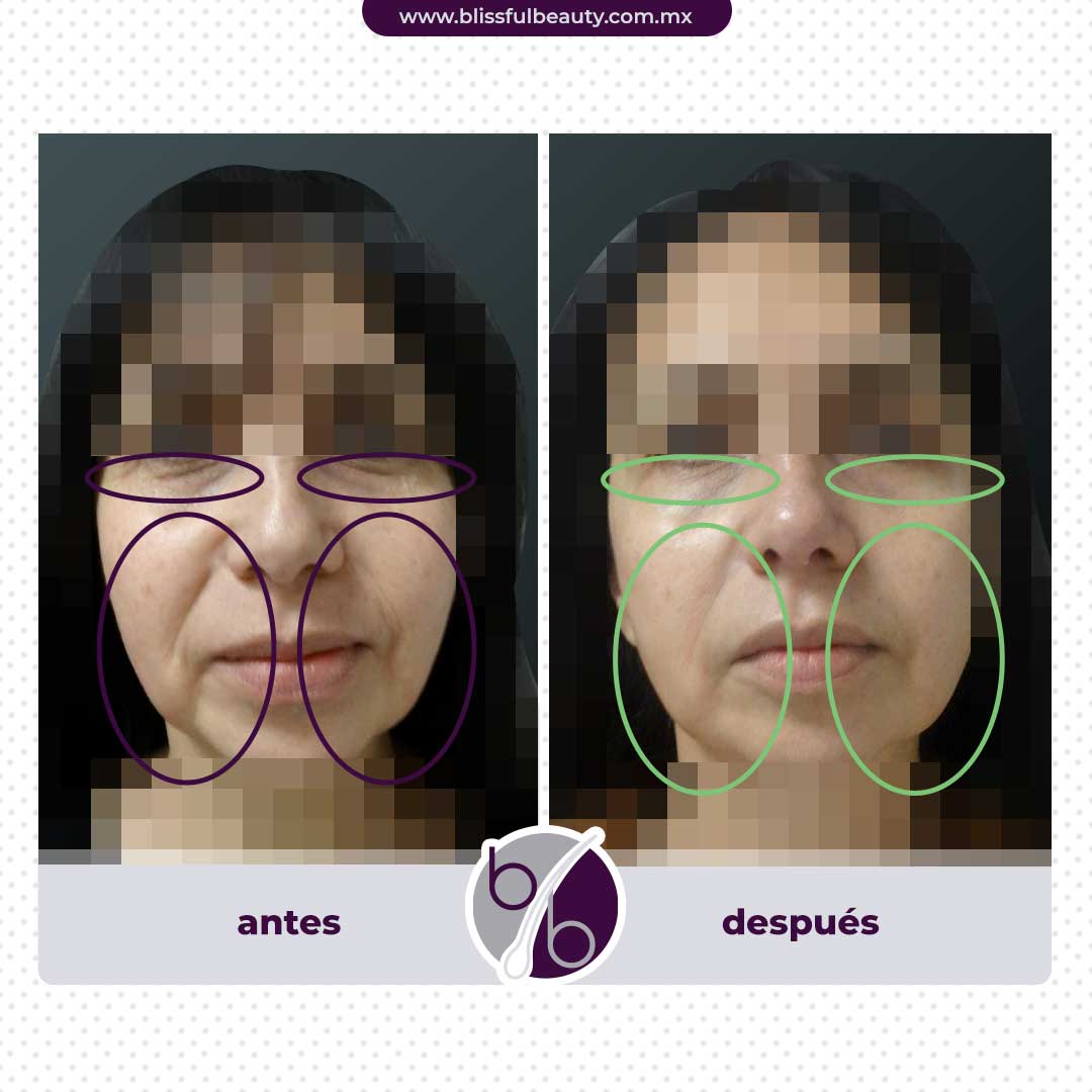 antes y después tratamiento facial antiage blissful beauty