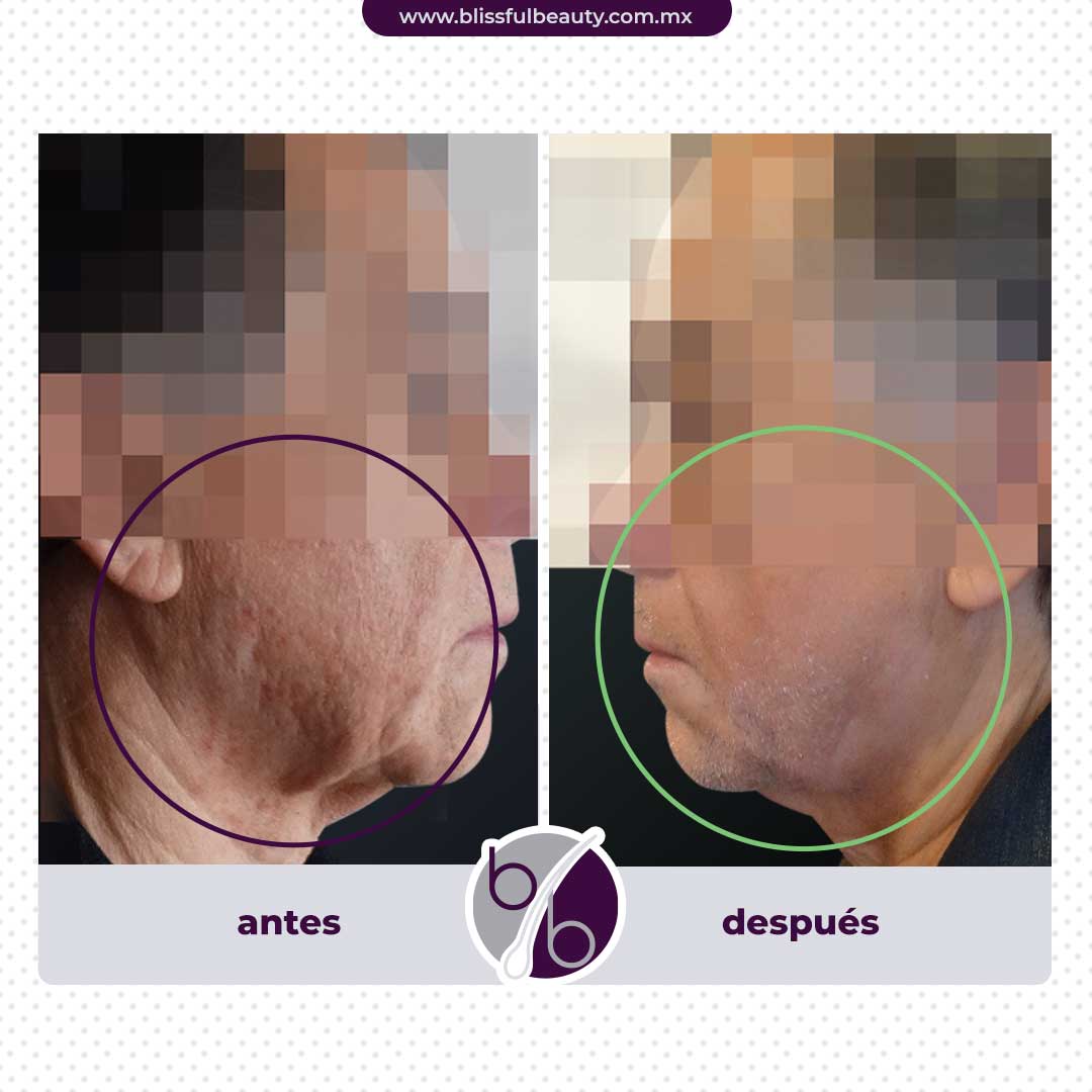antes y después tratamiento antiage para hombres de blissful beauty - lifting sin cirugía para hombres