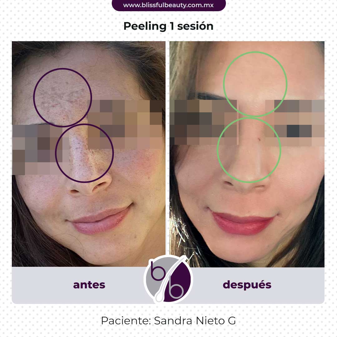 antes y después peeling facial