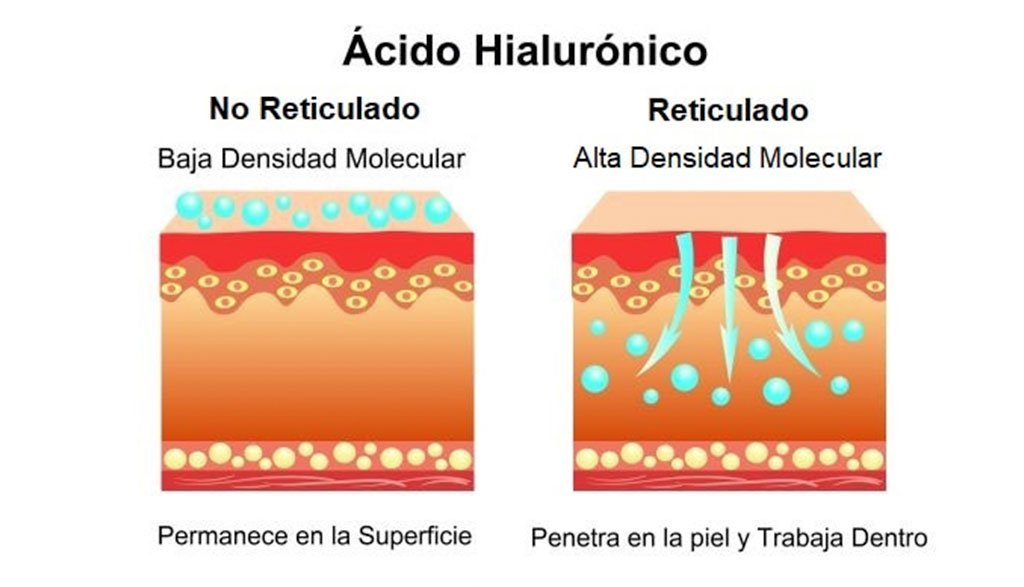 Ácido hialurónico reticulado y no reticulado