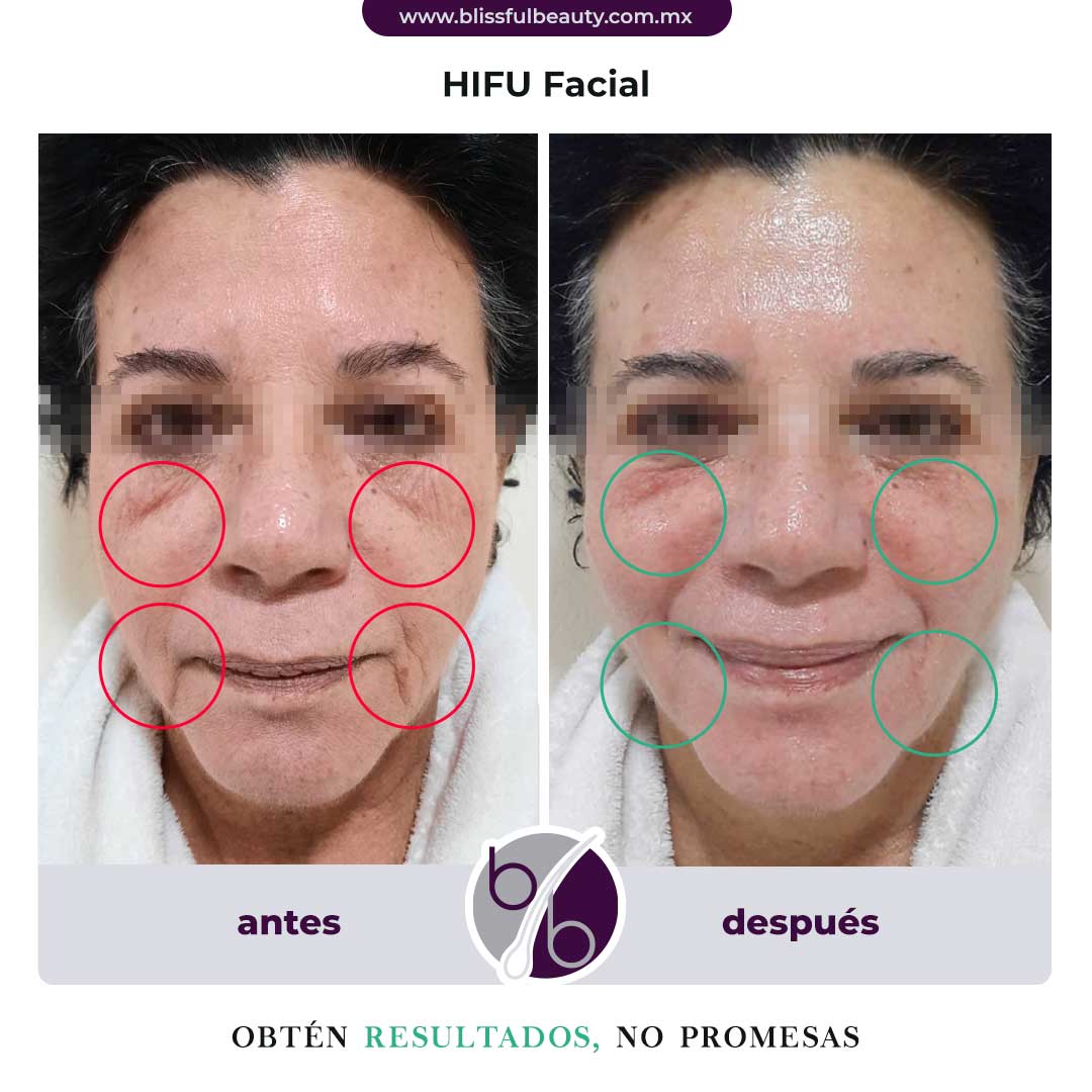 Antes y después de HIFU Facial