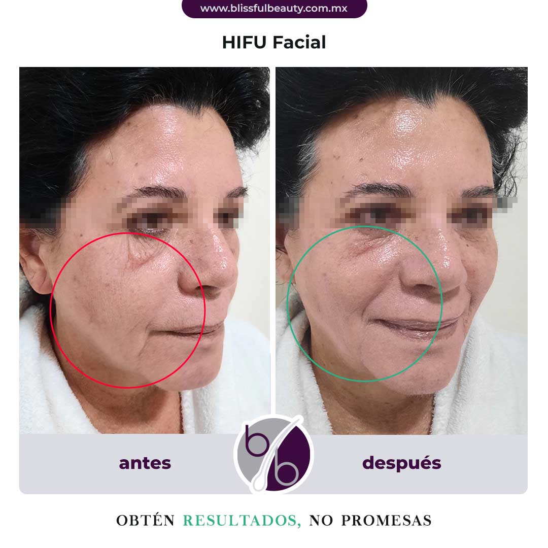 Antes y después de HIFU Facial