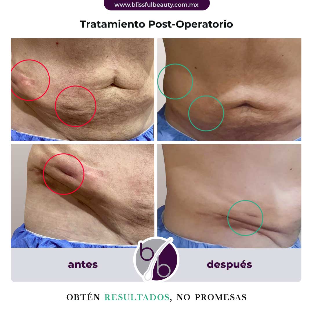 antes y después tratamiento post-operatorio